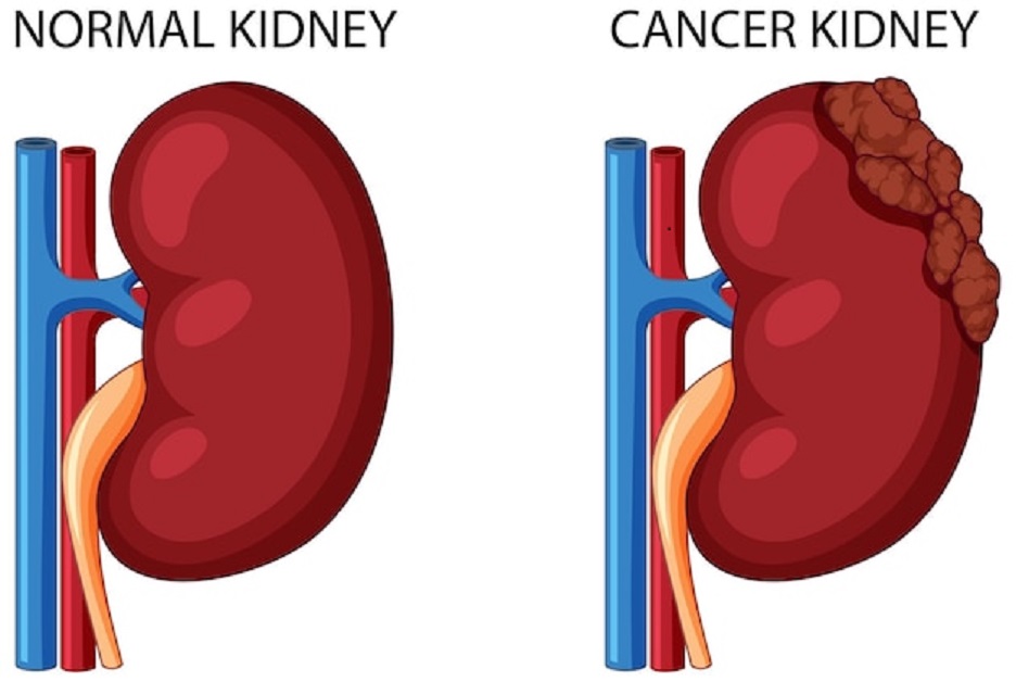 kidney cancer - Kjohealth