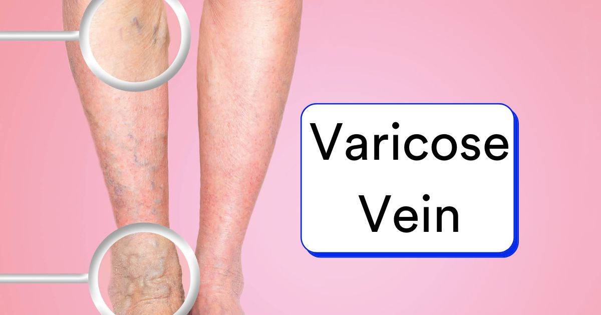 What happens if varicose veins are left untreated?