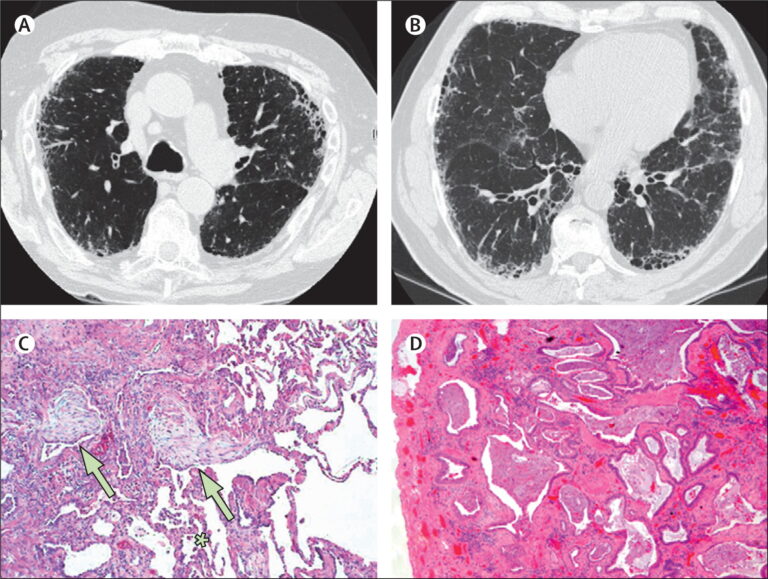 Can Regenerative Medicine Help Idiopathic Pulmonary Fibrosis (IPF)?