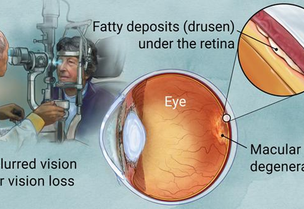 Introduction To the Treatment for Macular Degeneration