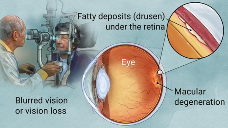 Introduction To the Treatment for Macular Degeneration